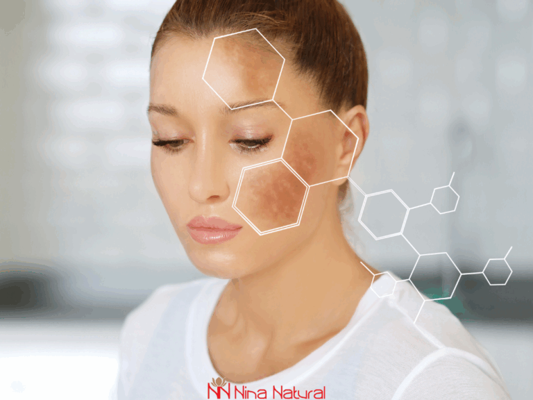 hiperpigmentacija na licu