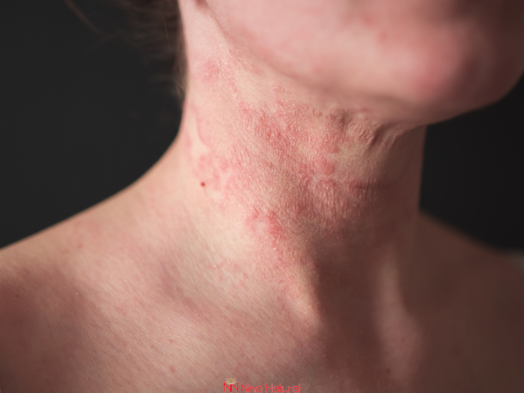 Seboreični dermatitis