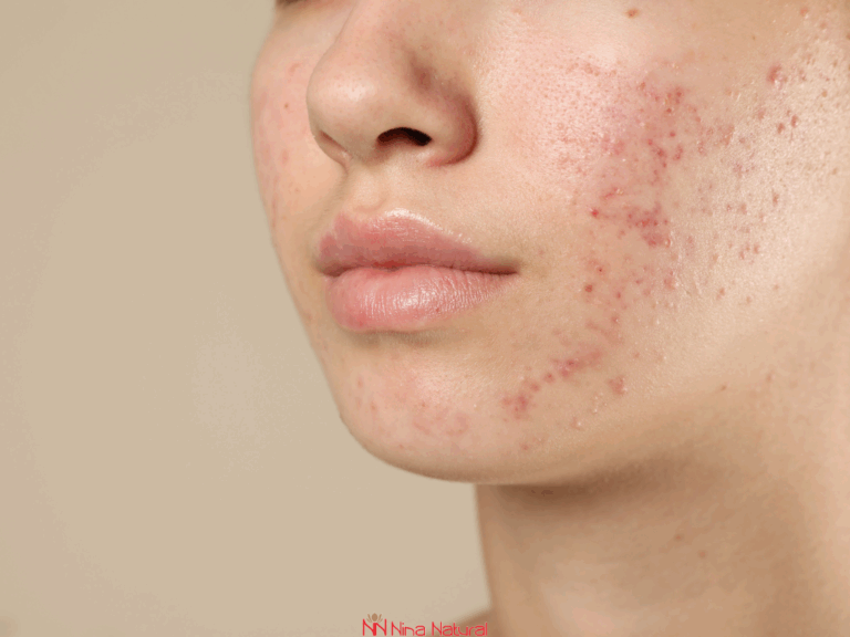 Kako prepoznati disbalans lojnih žlezda: sveobuhvatni vodič